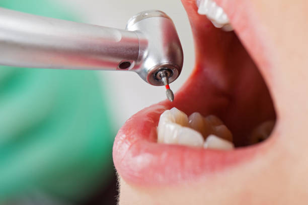 Urgent Tooth Repair in KY